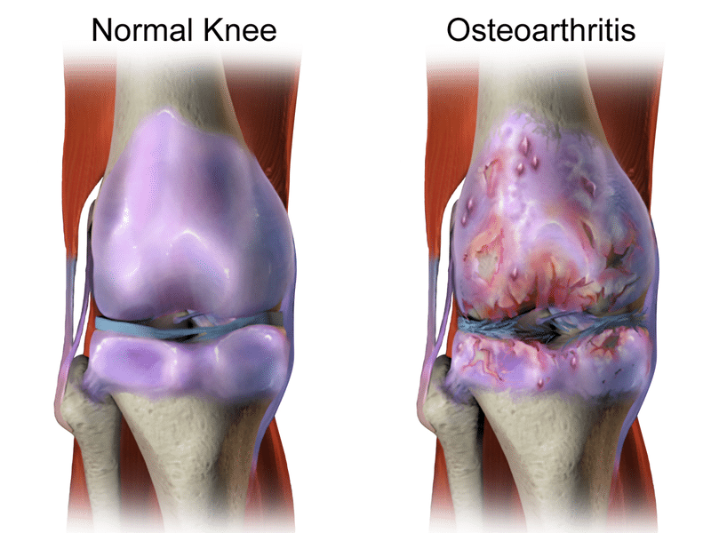 Normal Knee vs Osteoarthritis - Newcastle Research Institute - Genesis Research Services