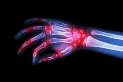 Rheumatoid Arthritis Hand - Newcastle Research Institute - Genesis Research Services