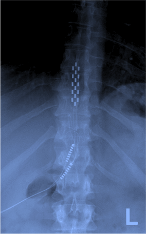 Spinal Cord Stimulation - Newcastle Research Institute - Genesis Research Services