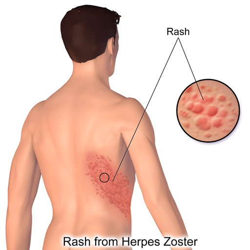 An illustration of a person's back showing Herpes Zoster (Shingles) Rash - Postherpetic Neuralgia