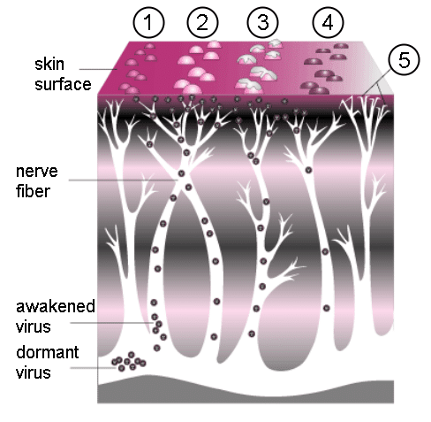 The progression of shingles (herpes zoster) in the skin. The virus lies dormant in the nerve fibers, and when awakened, migrates to the surface of the skin. Small bumps form on the skin that fill with lymph fluid, burst, then crust over.