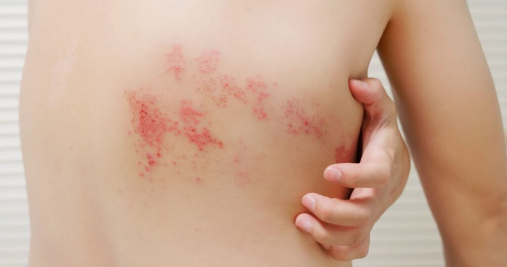 Postherpetic Neuralgia - Symptoms, Treatment & Clinical Trials -