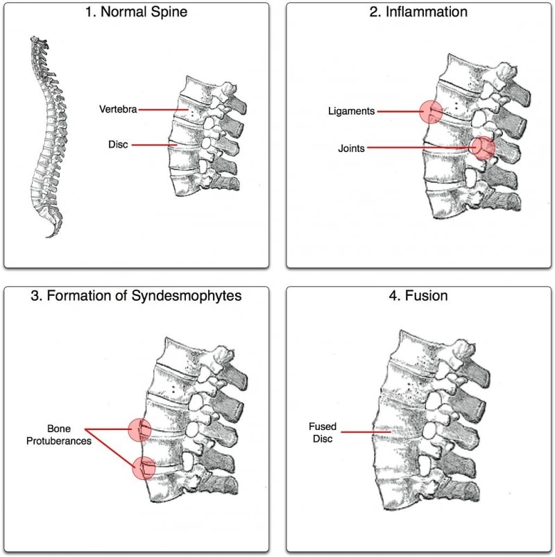 Ankylosing Spondylitis - Newcastle Research Institute - Genesis Research Services