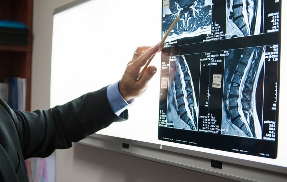 Dr Marc Russo X-Ray Ankylosing Spondylitis