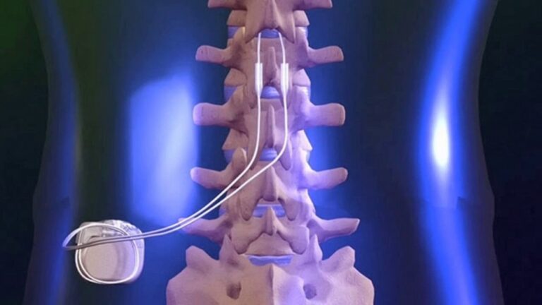 Spinal cord stimulation - Newcastle Research Institute - Genesis Research Services