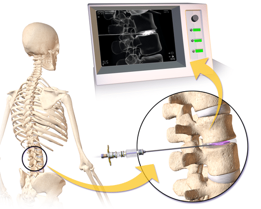 Discography for disc disease diagnosis - Newcastle Research Institute - Genesis Research Services