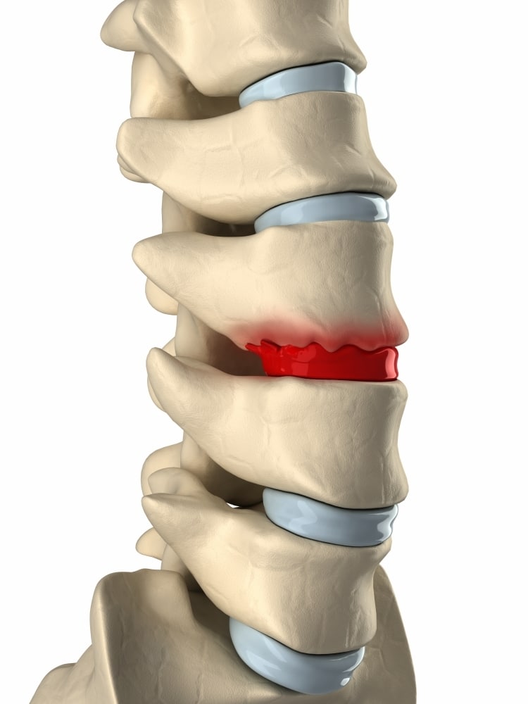 Degenerative disc disease herniated bulging disc