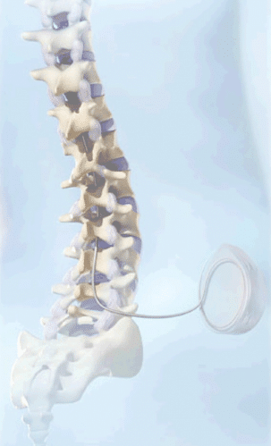 Intrathecal drug pump therapy chronic pain