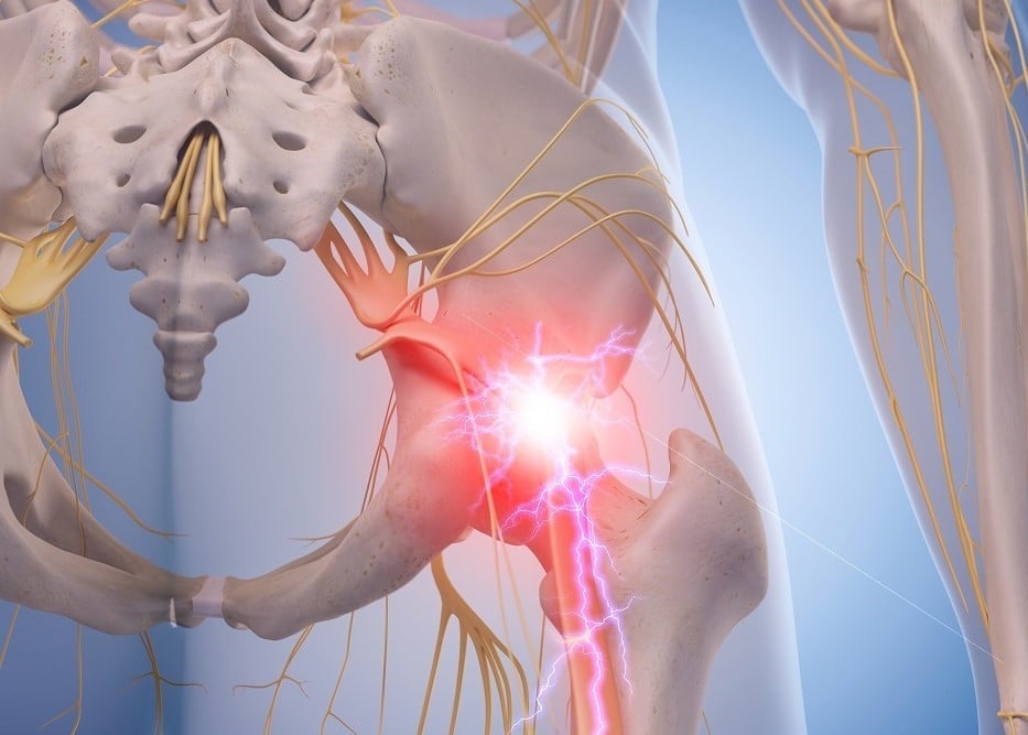 Sciatic nerve pain - Newcastle Research Institute - Genesis Research Services