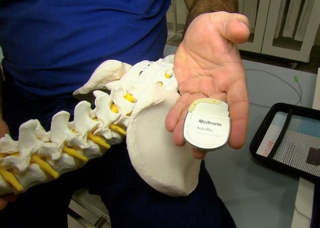 Medtronic spinal cord stimulator - Newcastle Research Institute - Genesis Research Services