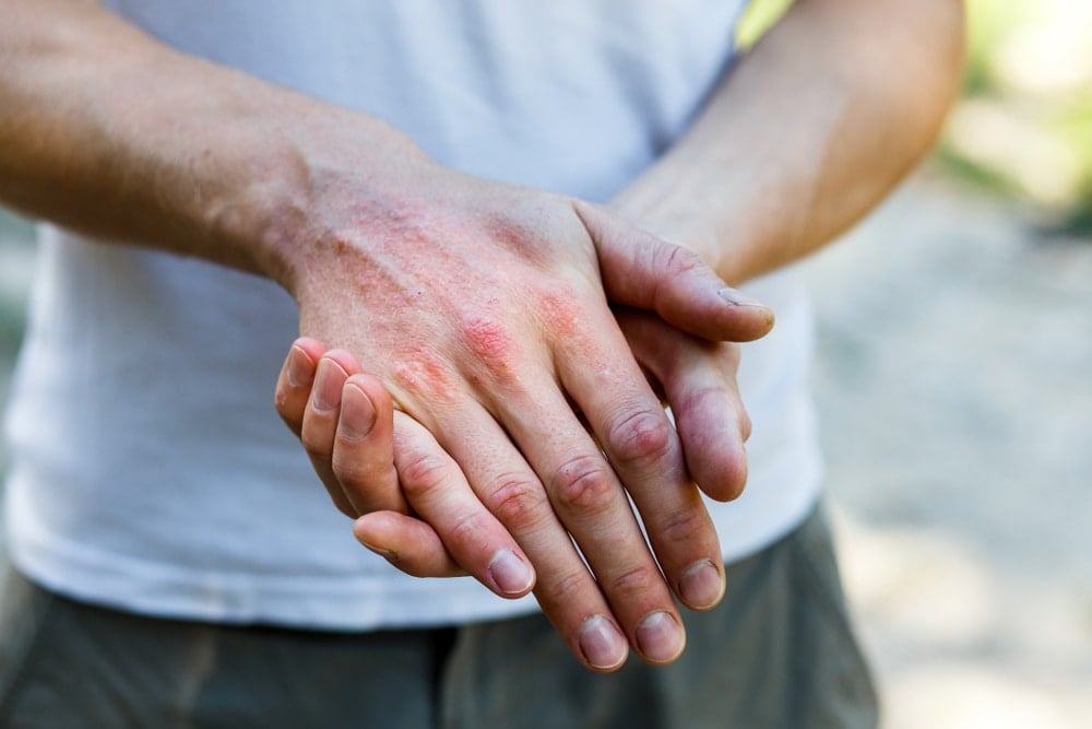 Psoriatic Arthritis - Diagnosis, Symptoms, Treatment, Clinical Trials