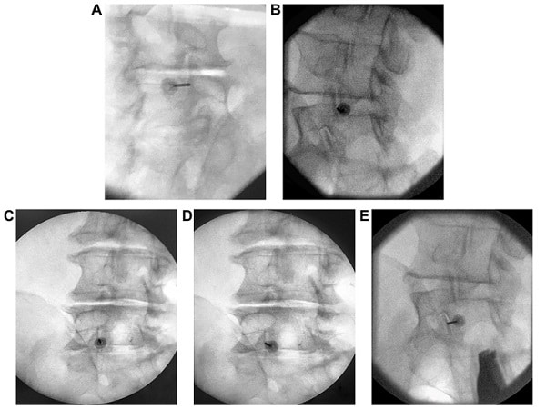 Multifidus-sparing radiofrequency neurotomy research