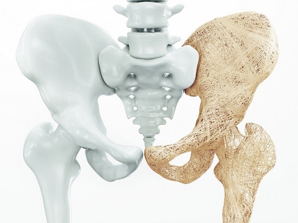 Research study for women with osteoporotic fracture