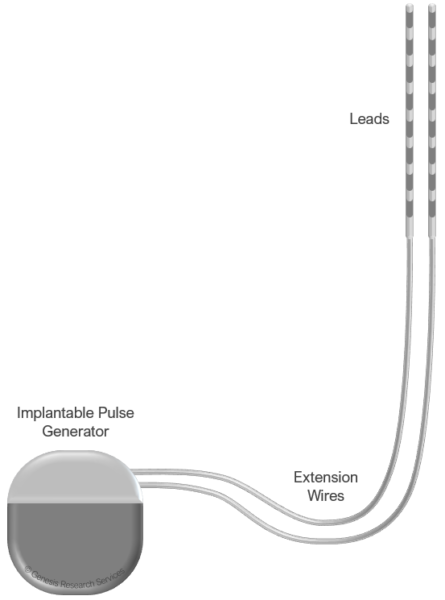 Simple diagram of a typical spinal cord stimulator device