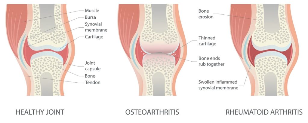 Healthy knee compared to osteoarthritis and rheumatoid arthritis - differences in joints