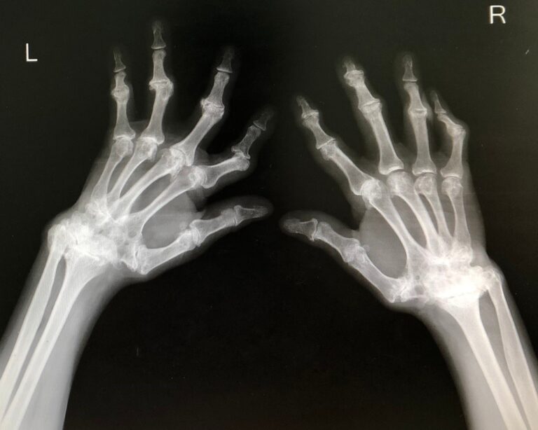 Osteoarthritis vs Rheumatoid Arthritis – What’s the Difference? - Osteoarthritis vs Rheumatoid arthritis,Types of arthritis,Osteoarthritis,Rheumatoid Arthritis