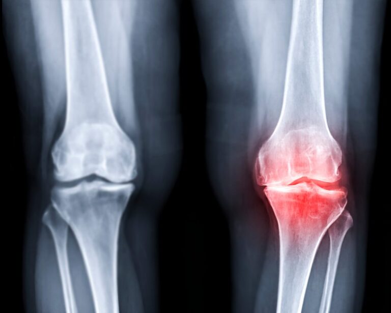 Osteoarthritis vs Rheumatoid Arthritis – What’s the Difference? - Osteoarthritis vs Rheumatoid arthritis,Types of arthritis,Osteoarthritis,Rheumatoid Arthritis