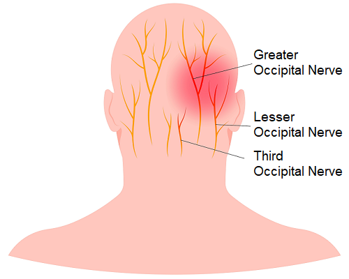 An illustration of the back of the head and neck that shows the occipital nerves, which can be stimulated for migraine relief.]